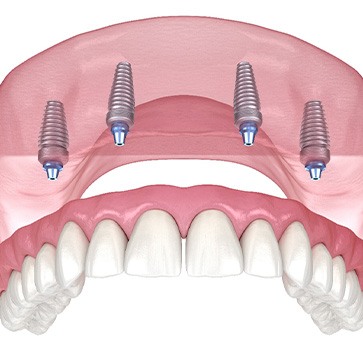 Illustration of an implant denture