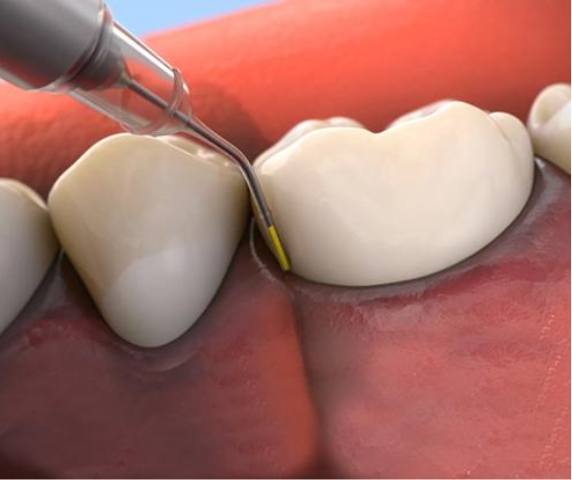 Animated topical antibiotic being applied to the gums
