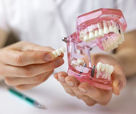 a dentist holding a model of dental implants