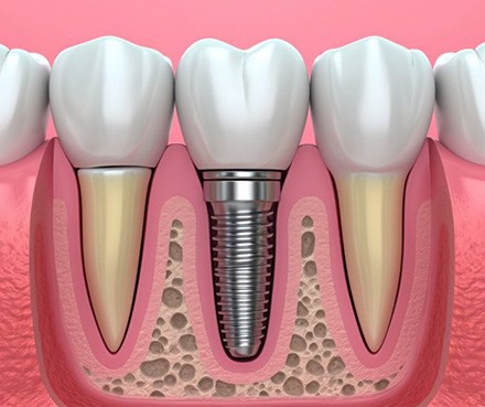 a 3D example of a dental implant undergoing osseointegration