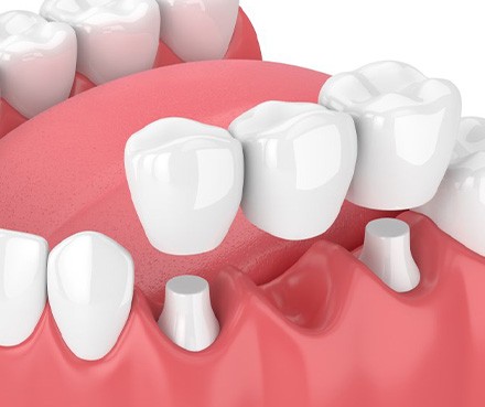 Illustration of dental bridge