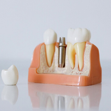 model of each part of a dental implant