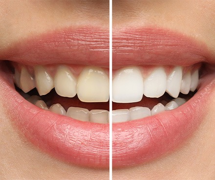 Closeup of a woman’s smile that’s halved to show the results of teeth whitening on one side