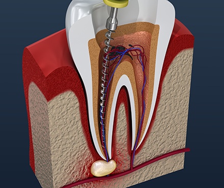 Woman with brown hair in dental chair undergoing root canal